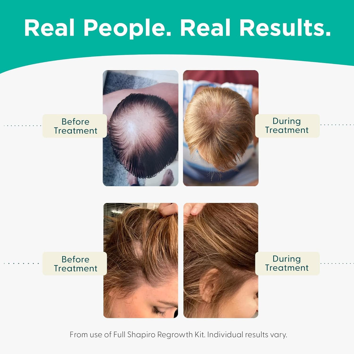 Vegan Hair Loss Shampoo for Thinning Hair | Experience Healthier, Fuller and Thicker Looking Hair (1 Month Supply)